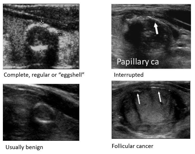 Calcificações periféricas