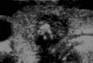 Macrocalcificações